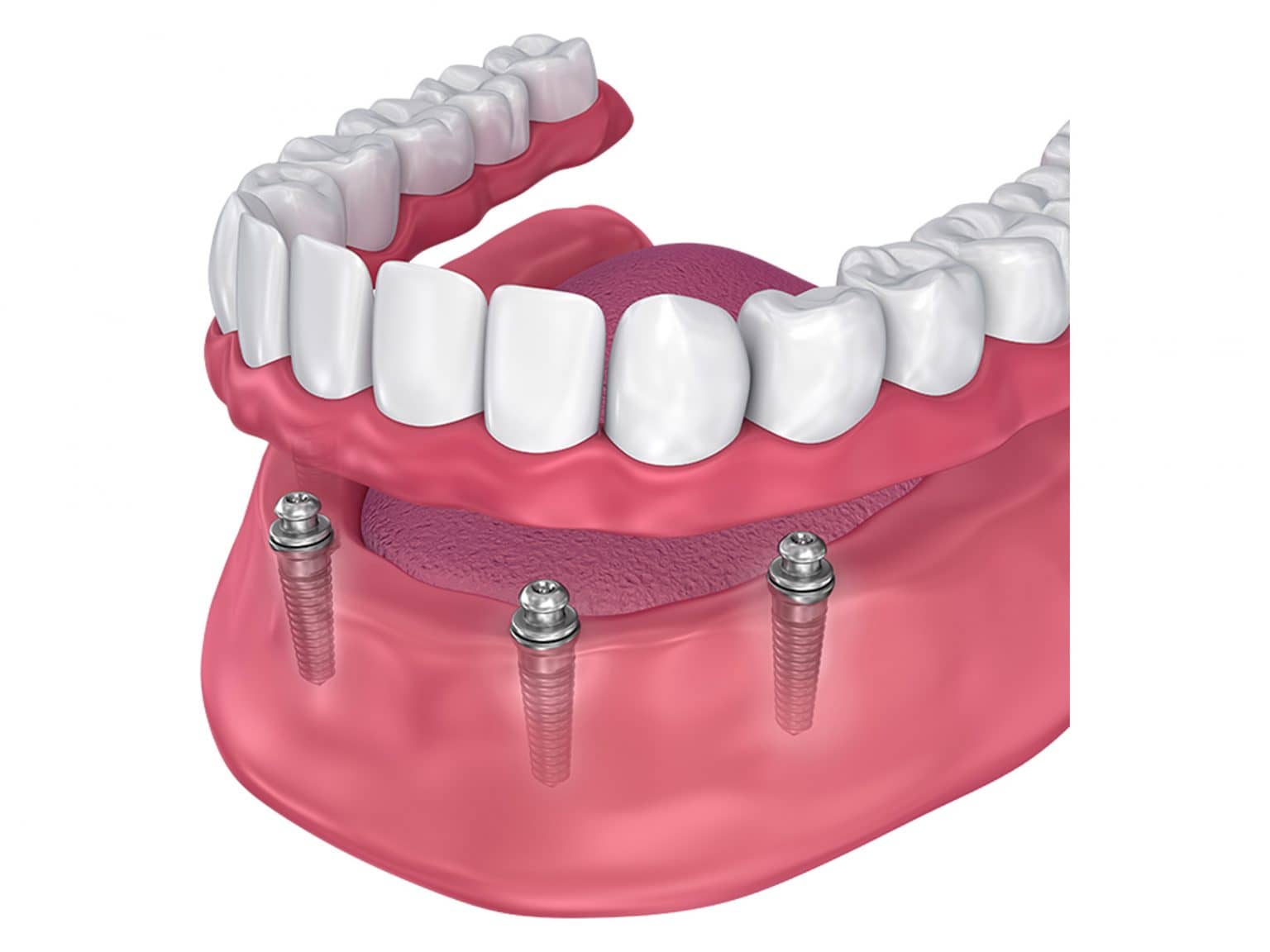 Implant Dentures in New Port Richey
